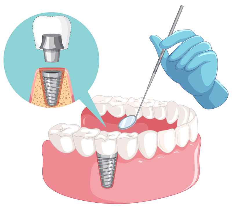 A dentist hand installing an inplant on a lower jaw portion of the mouth