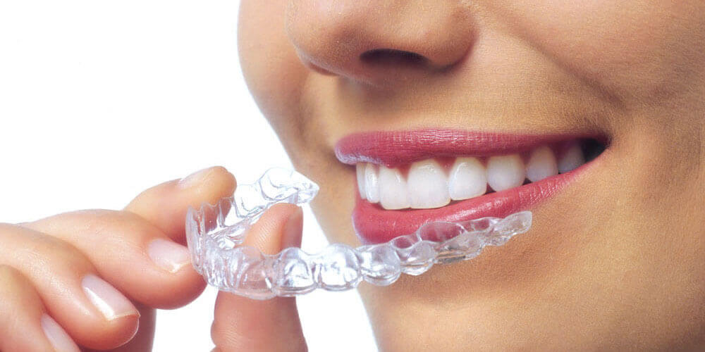 Invisalign/Clear Aligners