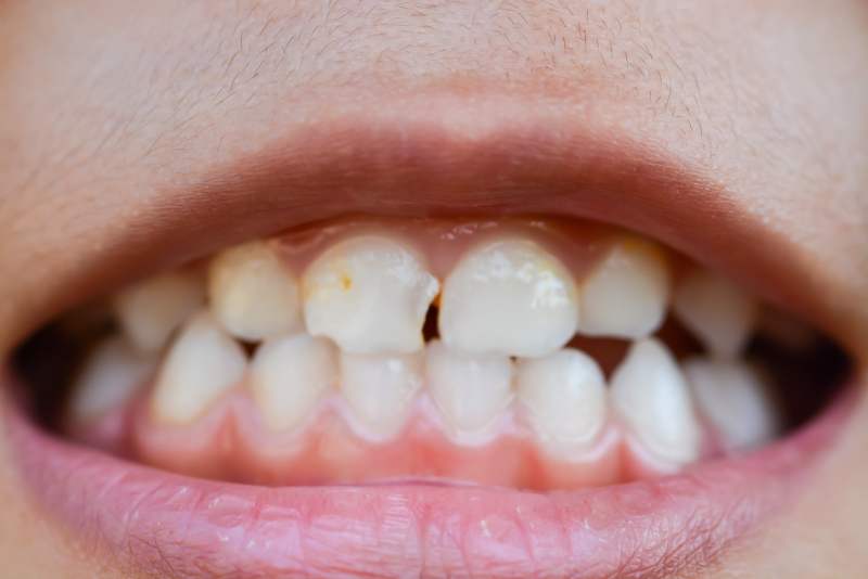 How Dentist Repair Chipped Tooth?