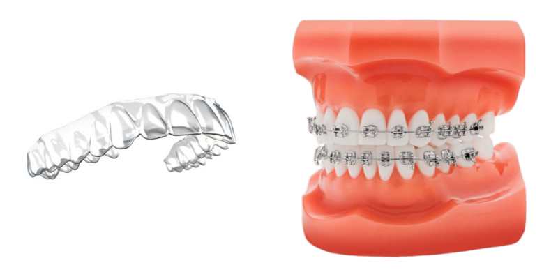 Clear Aligners vs. Braces: Understanding the Differences