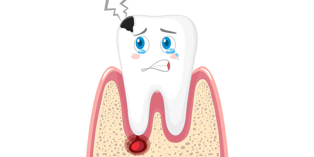 Dental CYST