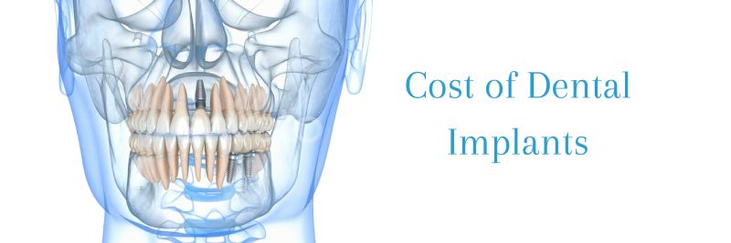 How Much Dental Implants Cost
