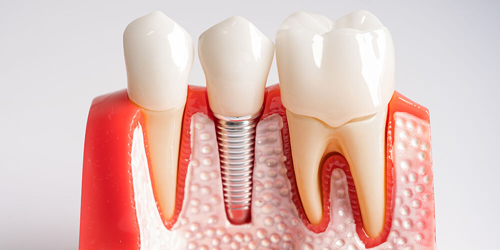 What are dental implants