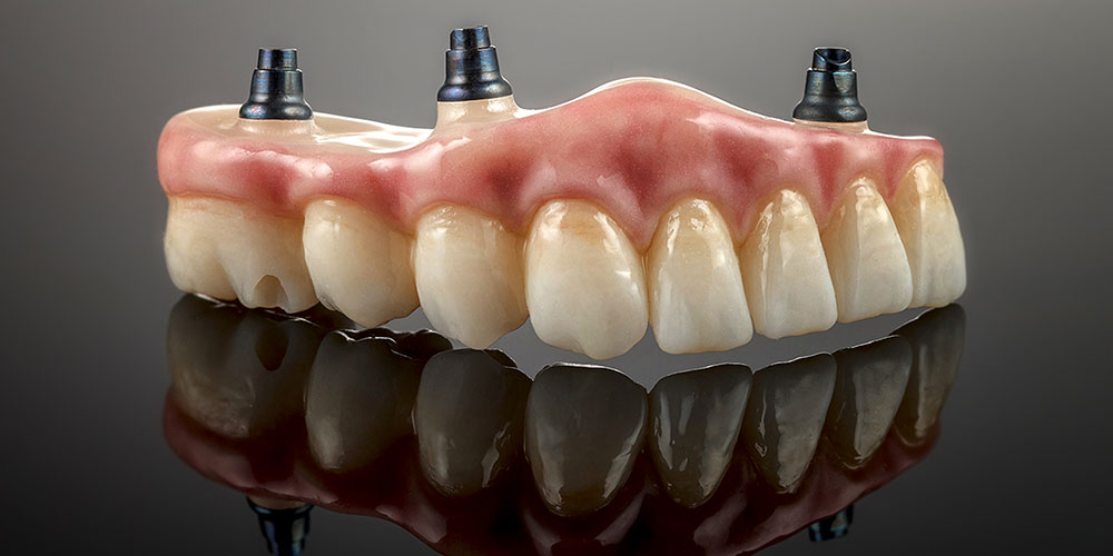 What is all on 4 implant