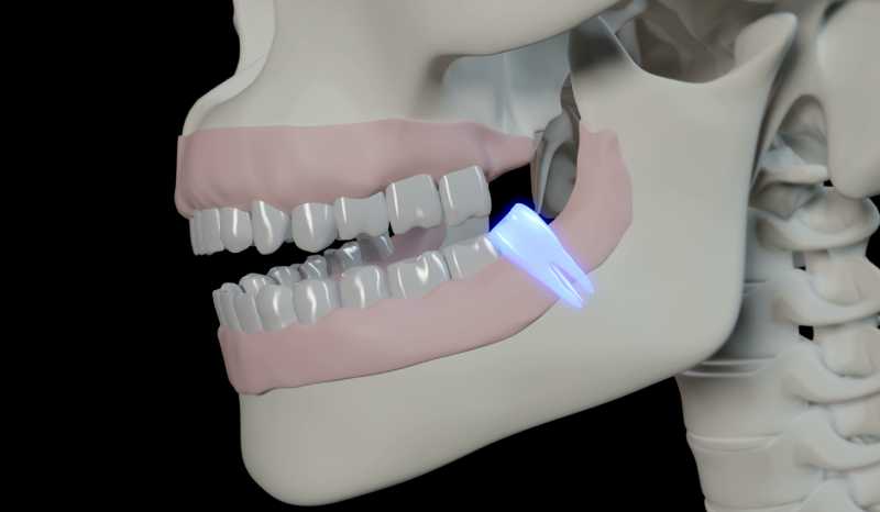 Why Should Wisdom Tooth Be Removed