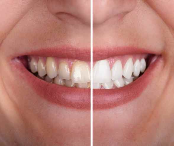 Patient receiving Zoom teeth whitening treatment